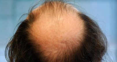 كيف يؤثر التوتر والإجهاد على صحة الشعر؟ image