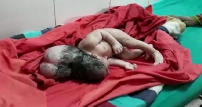 ولادة طفلة بـ"ثلاثة رؤوس"... تذهل الأطباء! image