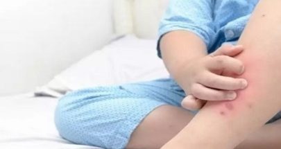 أعراض جلدية تشير إلى متلازمة الالتهابات المتعددة عند الأطفال image