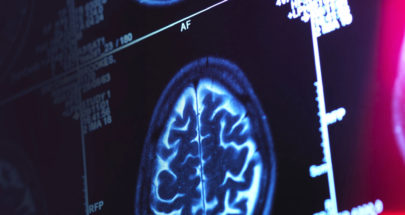 العلماء يحددون سبب تطور مرض ألزهايمر في الدماغ image