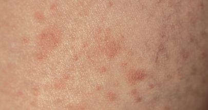 تعرف على العلامات والأعراض المنذرة بسرطان الجلد image