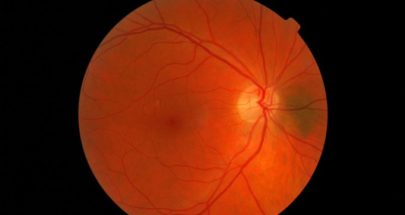 دراسة: شبكية العين تتنبأ بالنوبة القلبية قبل عام بنسبة 80 بالمئة image