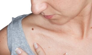 كيف نحمي أنفسنا من الإصابة بسرطانات الجلد؟ image