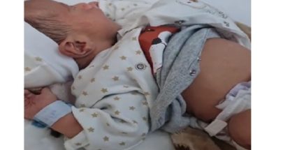 حالة ولادة نادرة: سيدة تونسية تضع مولودا يحمل شقيقه التوأم في بطنه image