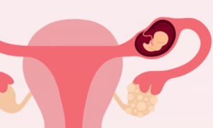 الحمل خارج الرحم.. ما أعراضه؟ image